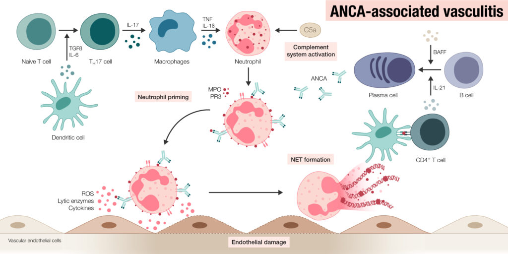 Graphical abstract summarizing the pathogenesis of ANCA-associated vasculitis.