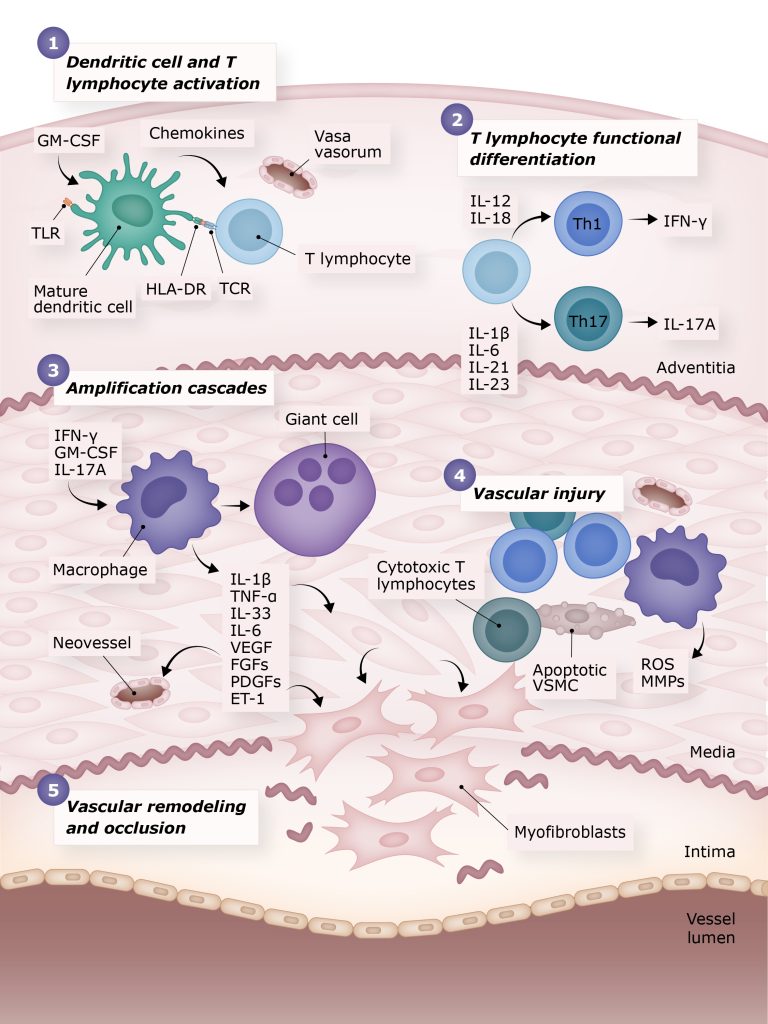 Pathogenesis of giant cell arteritis (GCA). Scientific illustration