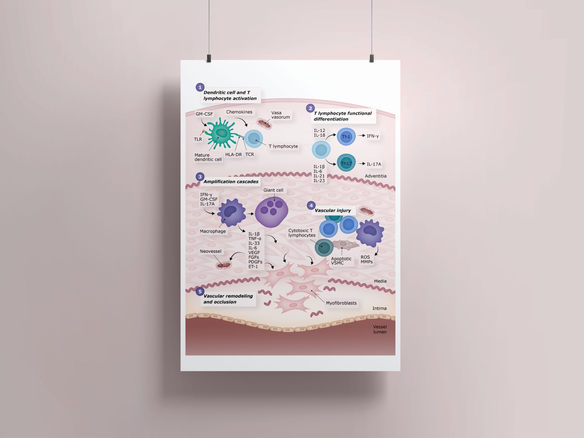 Scientific illustration created to visually summarize the pathogenesis of giant cell arteritis